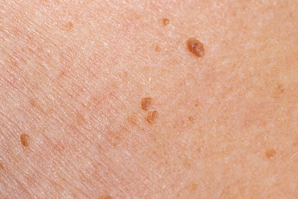 CONGENITAL SKIN TUMOURS